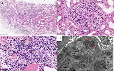 Case Report: Endocapillary Glomerulopathy Associated With Large Granular T Lymphocyte Leukemia